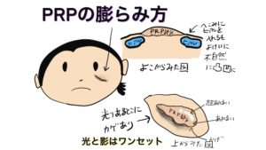 PRPの膨らみ