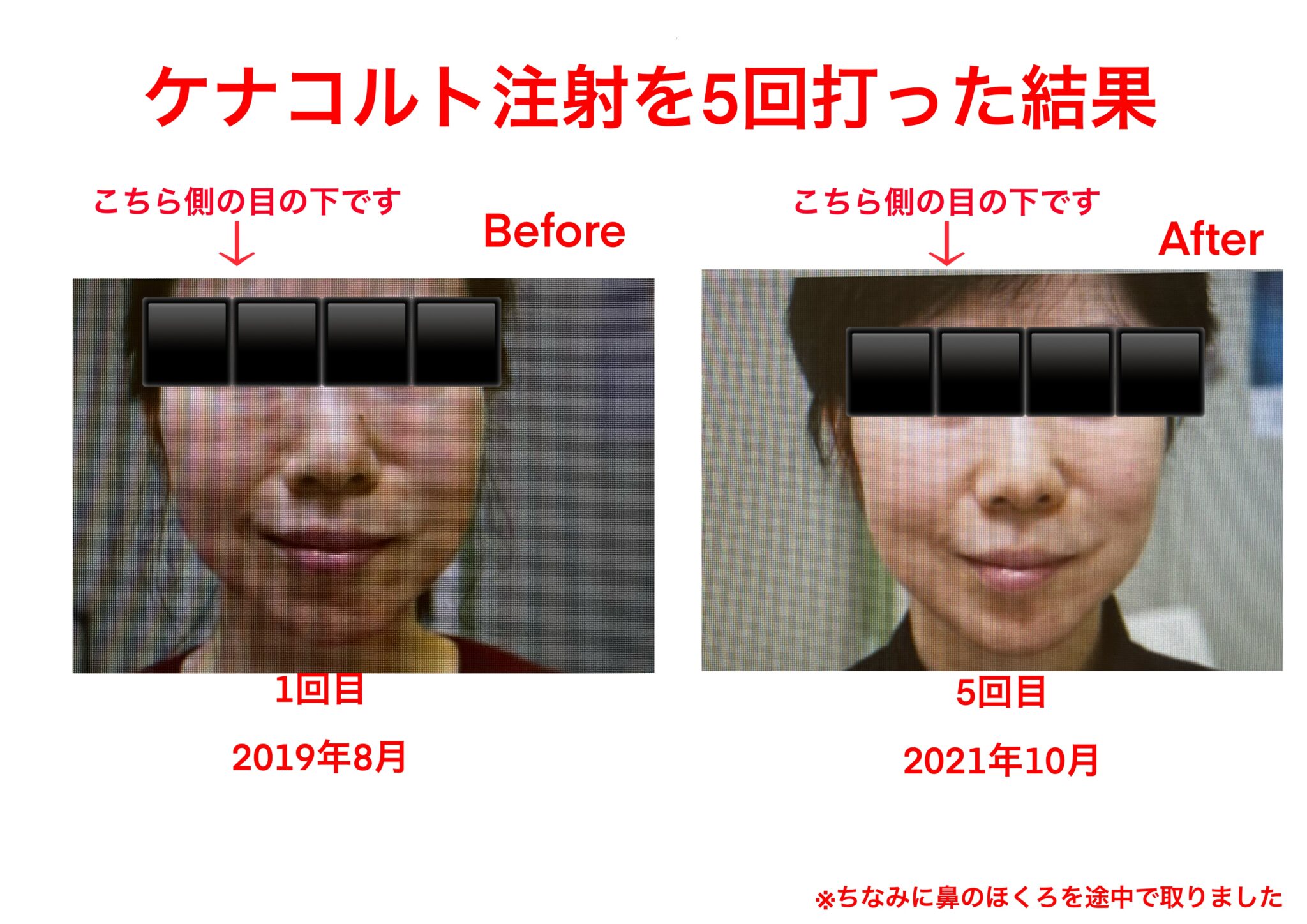 目の下のしこりにケナコルト注射6回【結論:かなり良くなりました】 もかたろーの美容整形blog 目の下のしこりにケナコルト注射6回【結論:かなり良くなりました】 もかたろーの美容整形blog