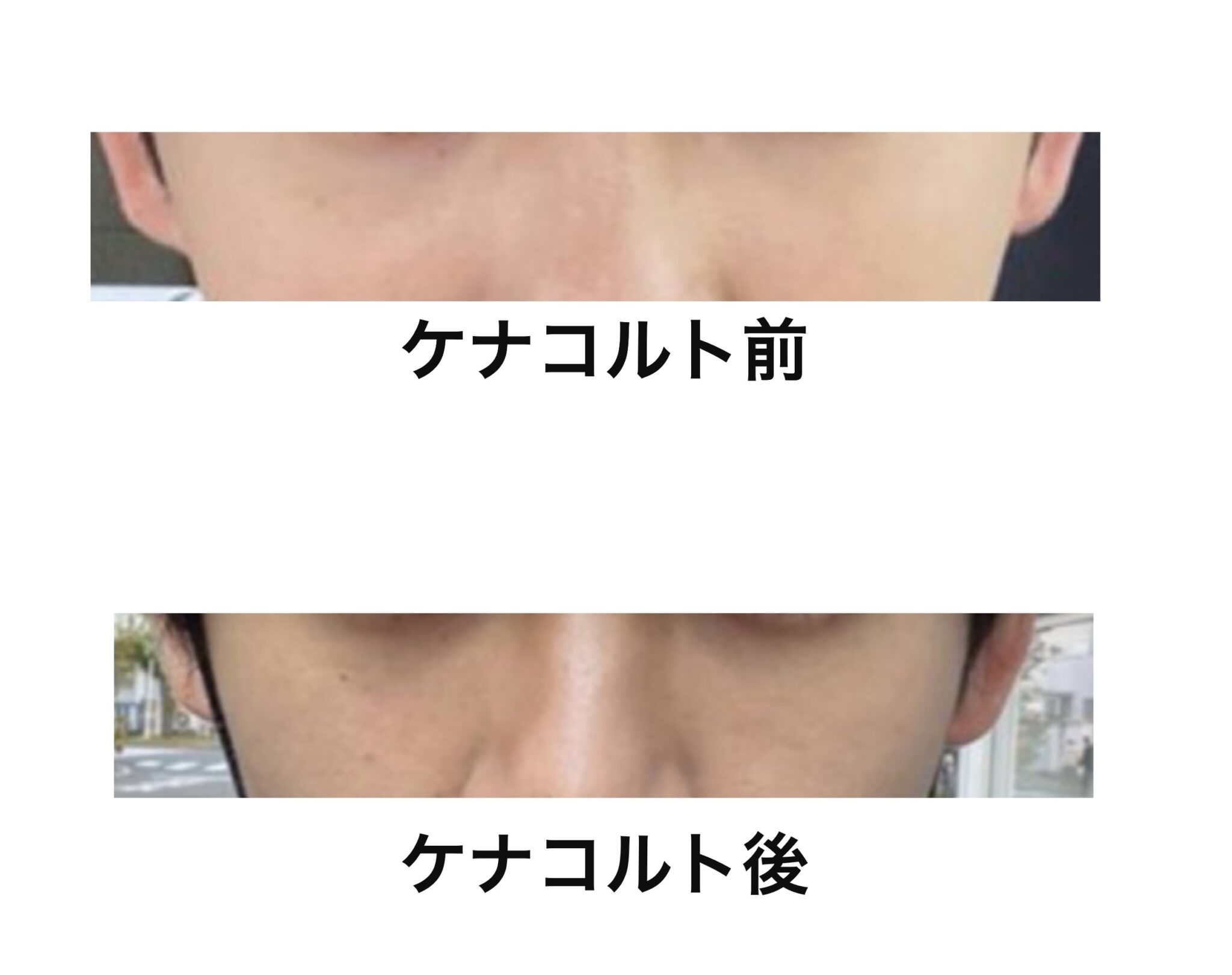 目の下のしこりにケナコルト注射6回【結論:かなり良くなりました】 もかたろーの美容整形blog 目の下のしこりにケナコルト注射6回【結論:かなり良くなりました】 もかたろーの美容整形blog
