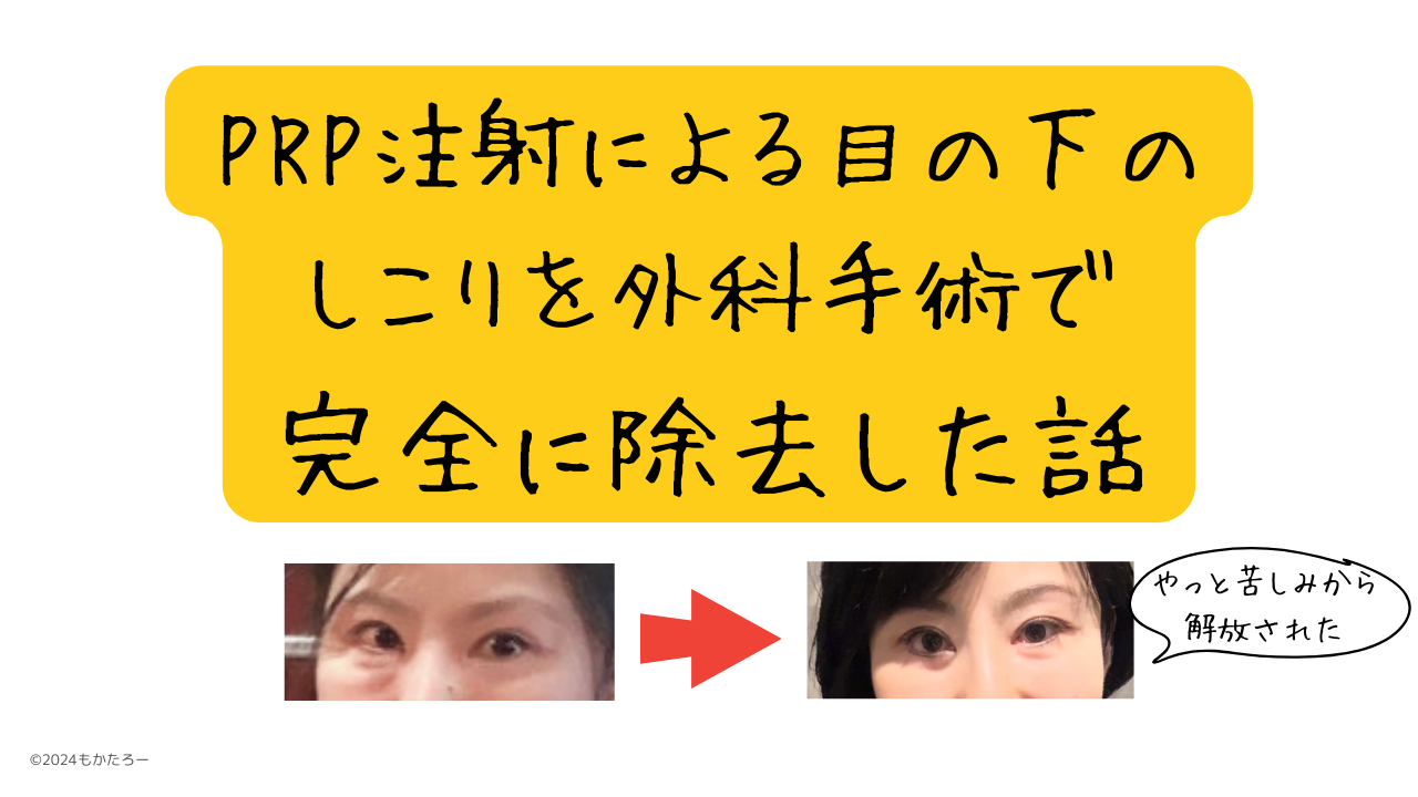 PRP 注射による目の下のしこりを外科手術で完全に除去した話